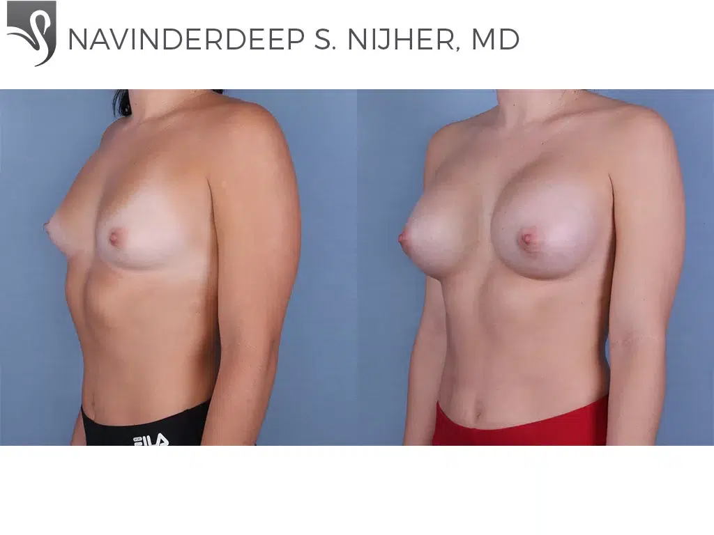 Before and After Image: Breast Augmentation Case #65379 - left-front-oblique