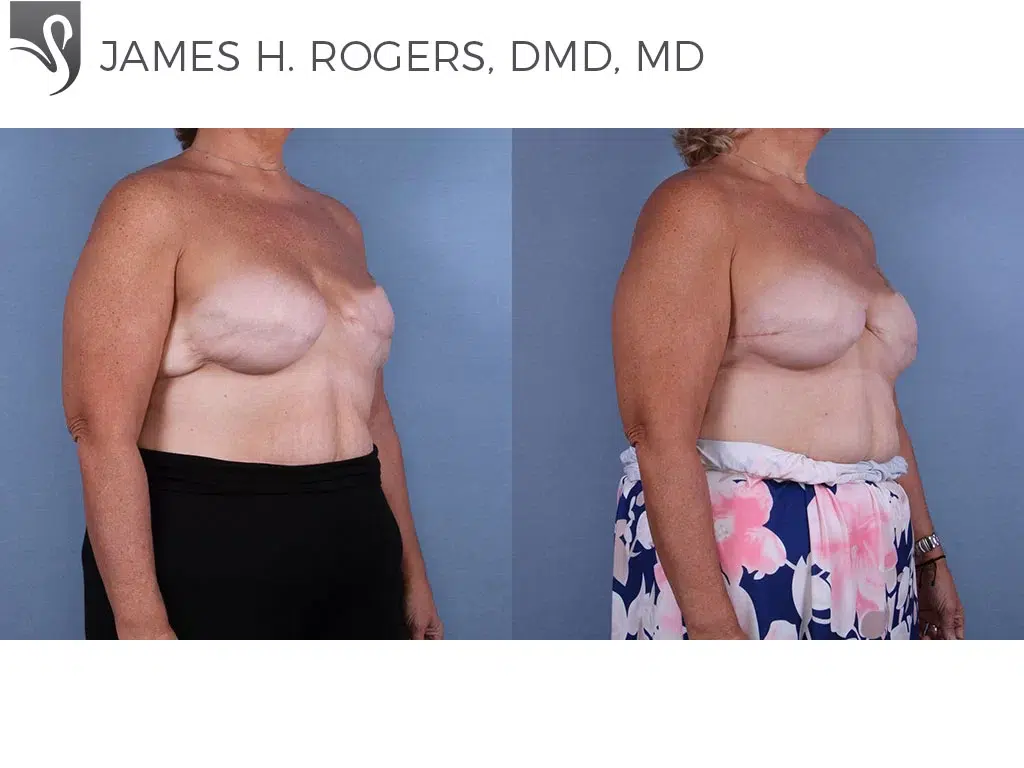 Before and After Image: Breast Reconstruction Case #65479 - right-front-oblique