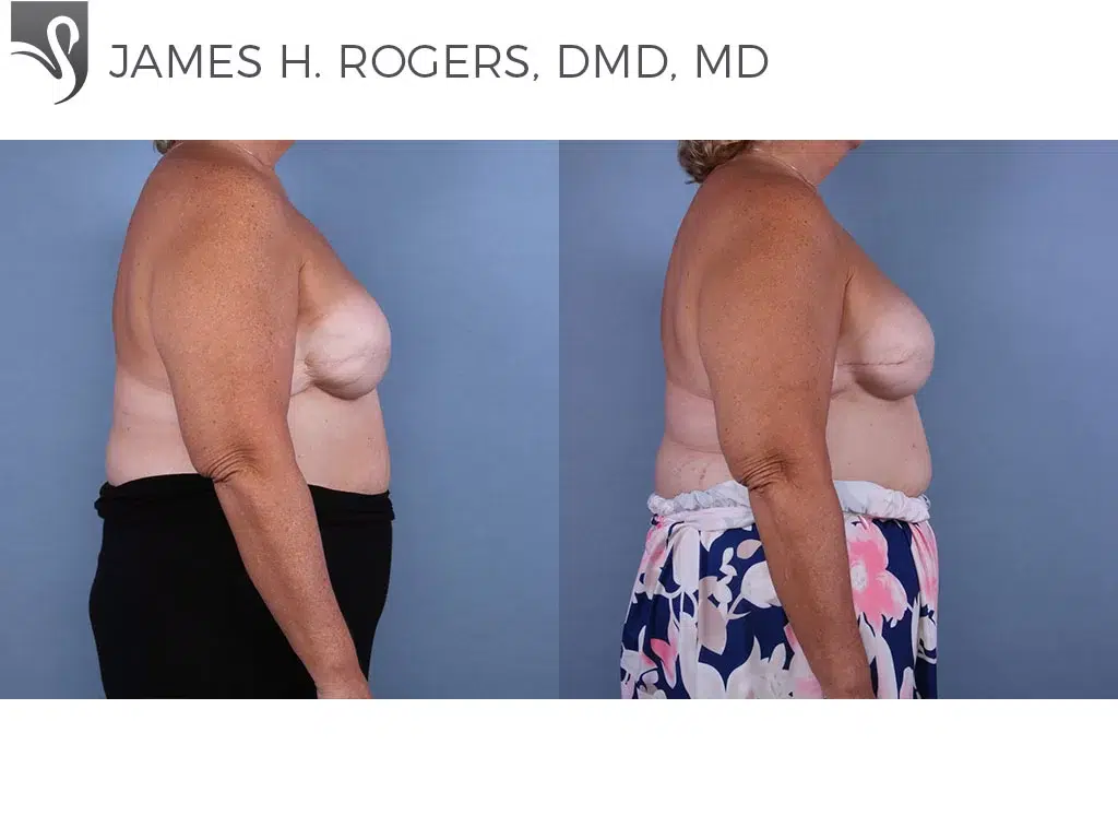 Before and After Image: Breast Reconstruction Case #65479 - right-side