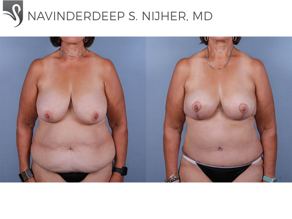 Before and After Image: Breast Lift (Mastopexy) Case #65562 - front