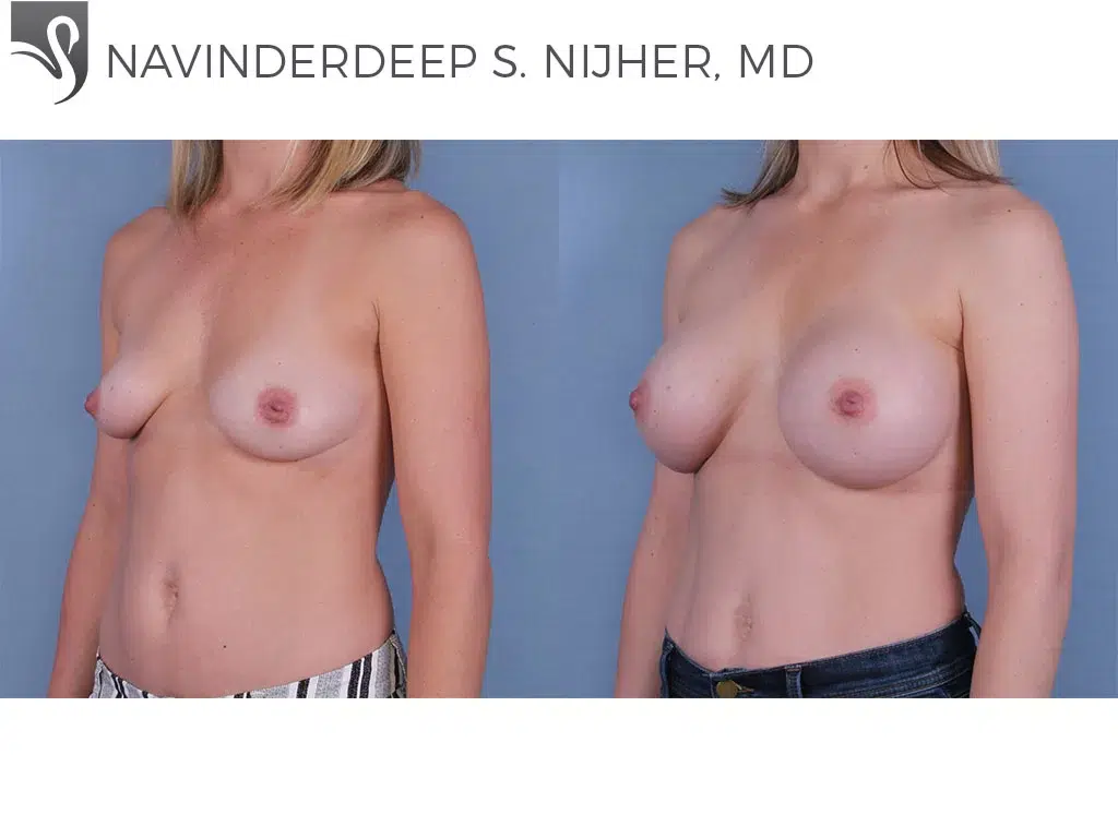 Before and After Image: Breast Augmentation Case #65571 - left-front-oblique