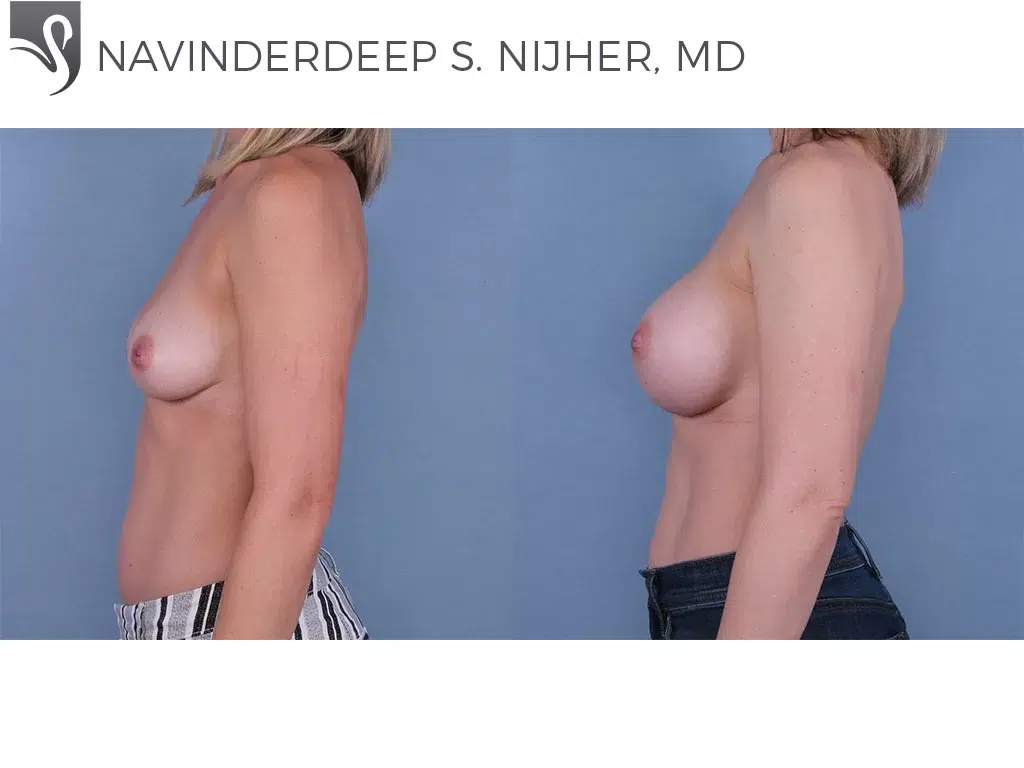 Before and After Image: Breast Augmentation Case #65571 - left-side
