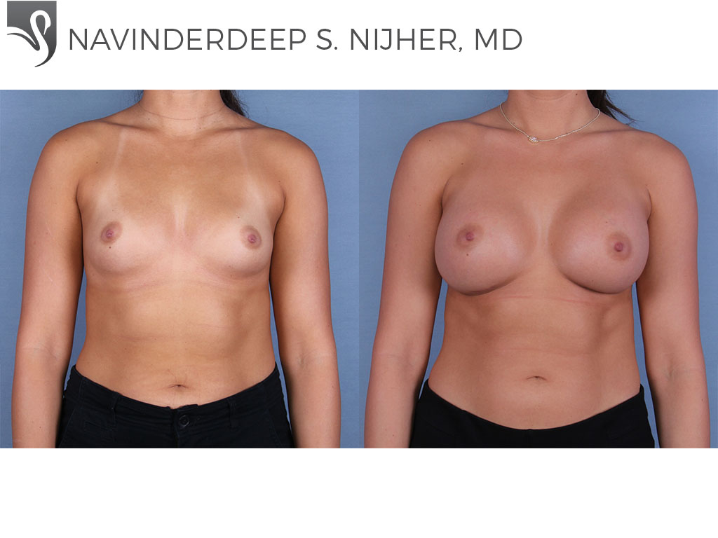 Before and After Image: Breast Augmentation Case #65649 - front