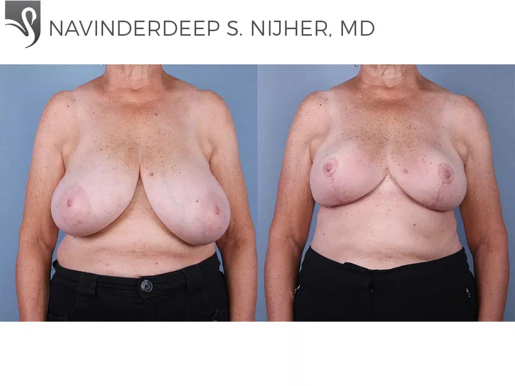 Before and After Image: Female Breast Reduction Case #65908 - front