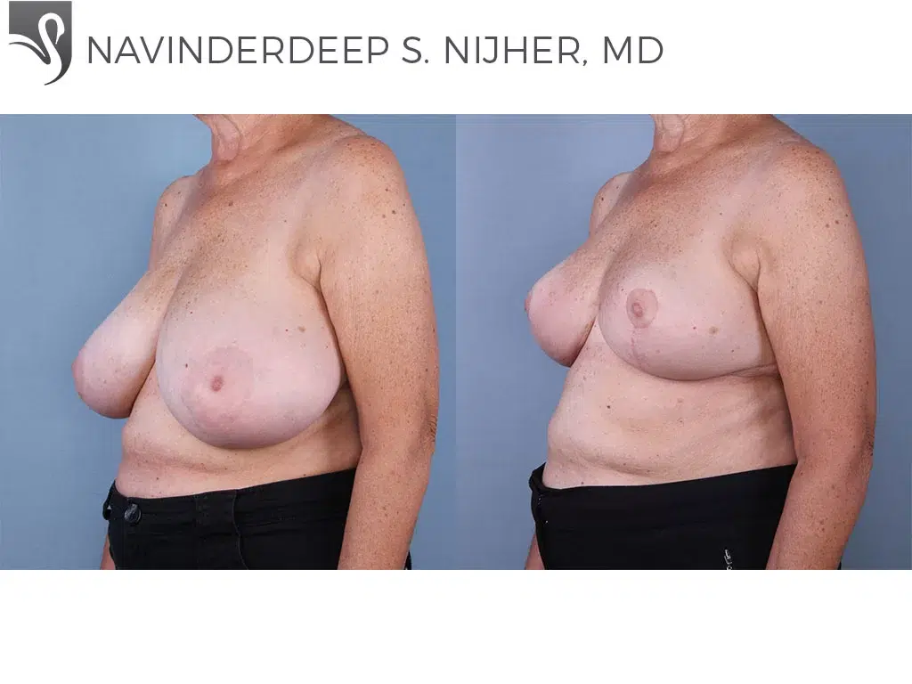 Before and After Image: Female Breast Reduction Case #65908 - left-front-oblique