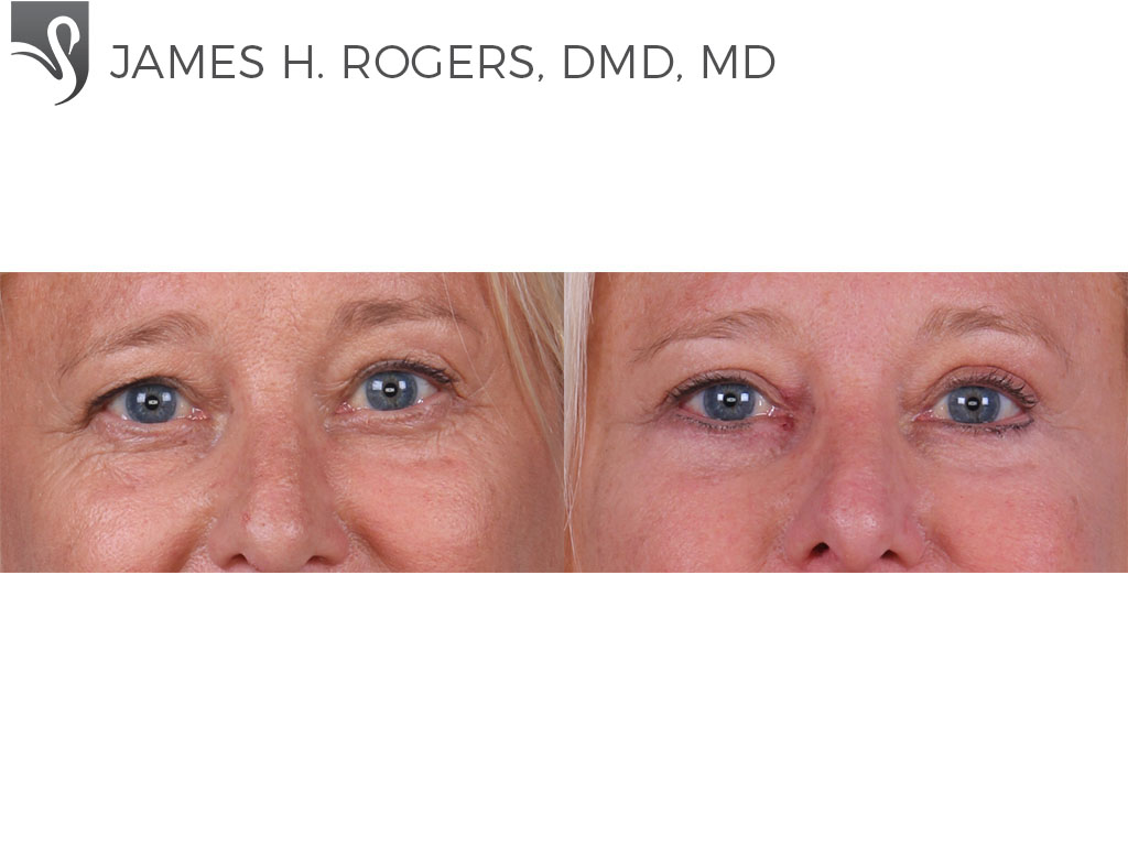 Before and After Image: Eyelid Surgery Case #66077 - front