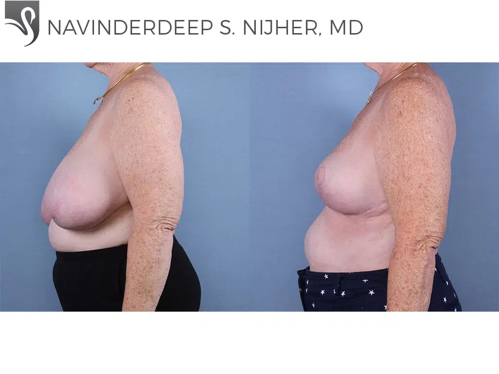 Before and After Image: Female Breast Reduction Case #66136 - left-side