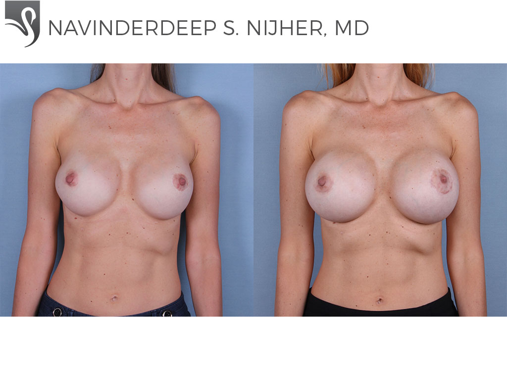 Before and After Image: Breast Revisions Case #66192 - front