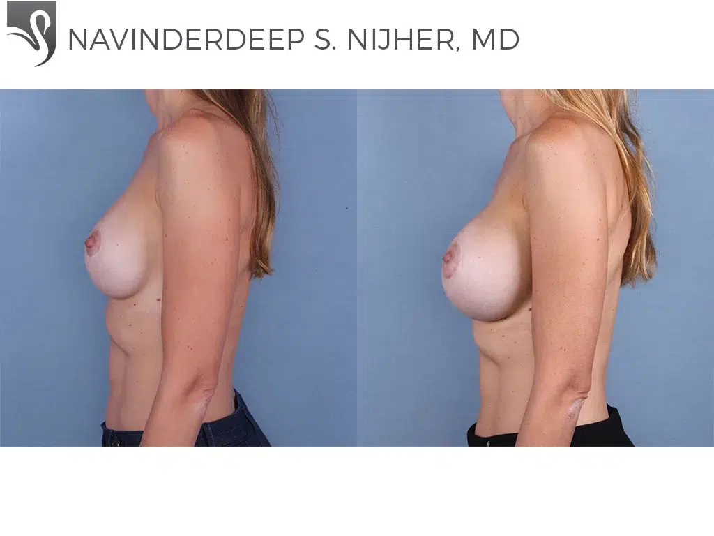Before and After Image: Breast Revisions Case #66192 - left-side
