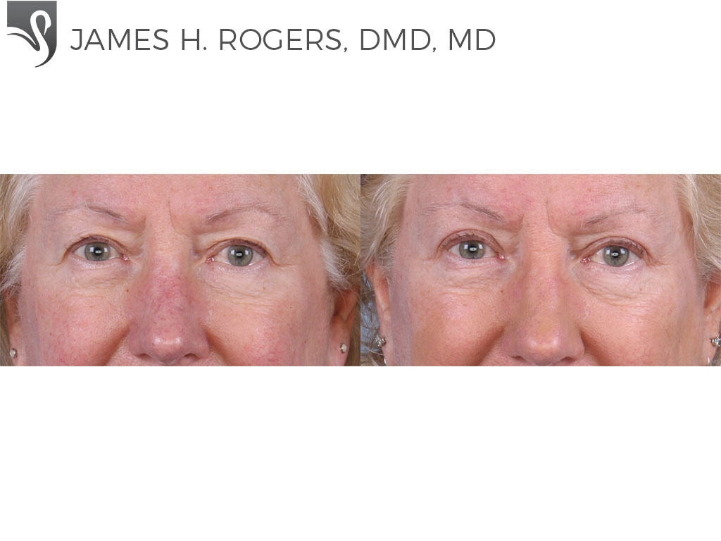 Before and After Image: Eyelid Surgery Case #66240 - front