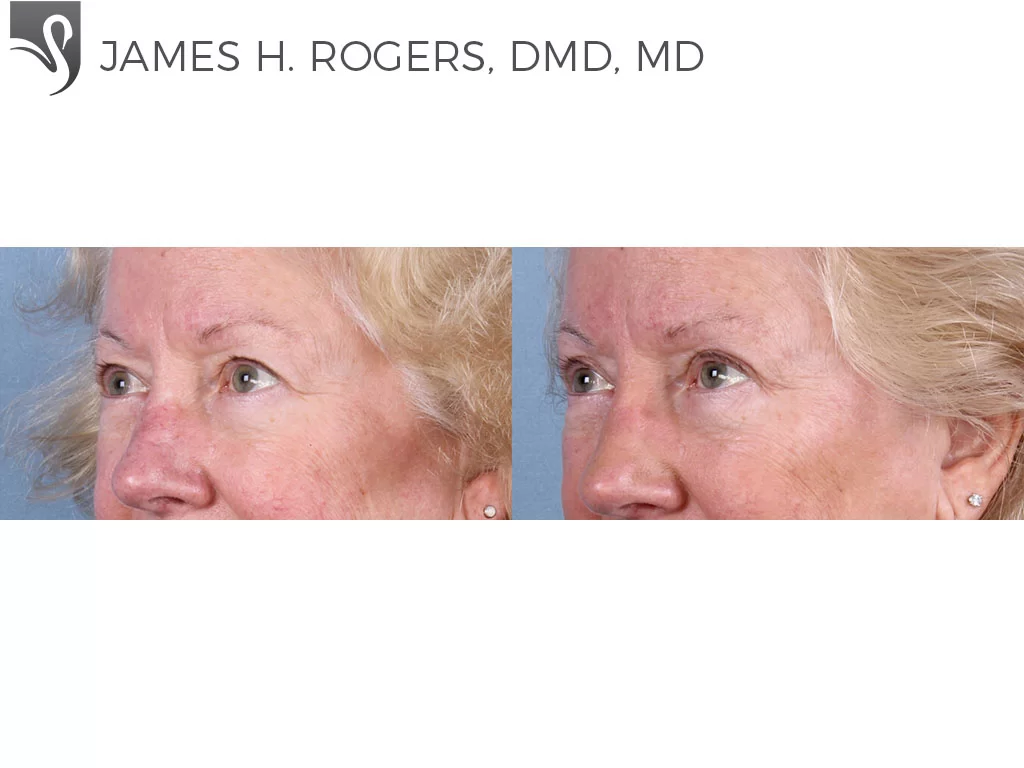 Before and After Image: Eyelid Surgery Case #66240 - left-front-oblique