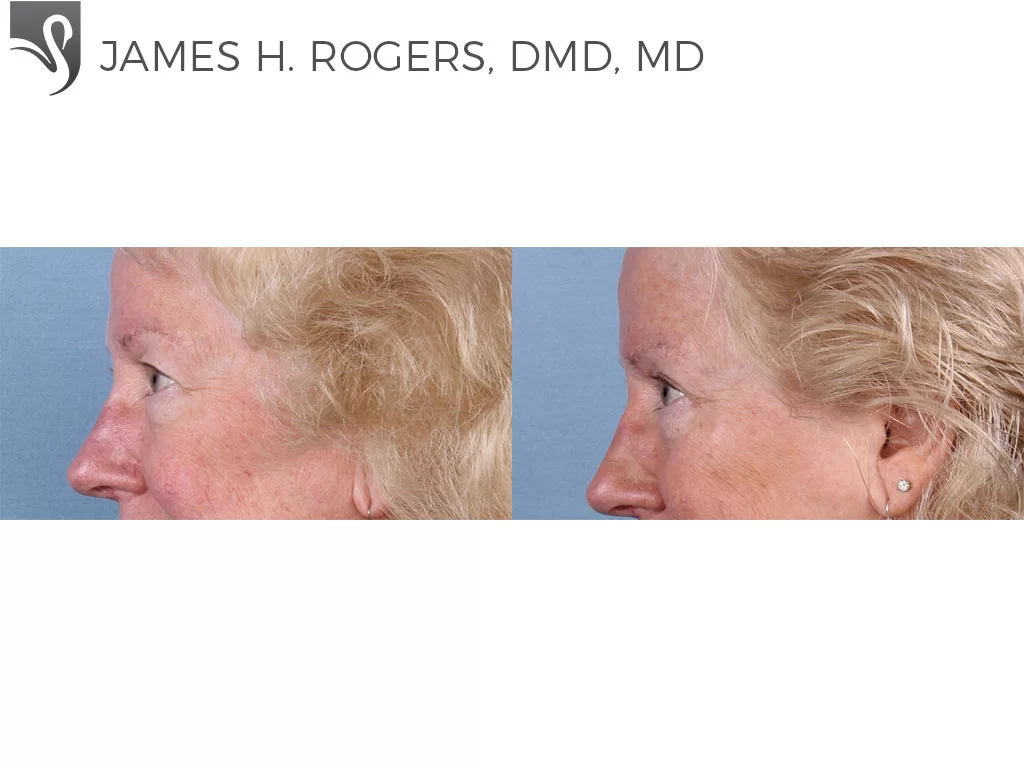 Before and After Image: Eyelid Surgery Case #66240 - left-side