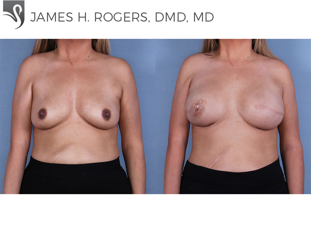 Before and After Image: Breast Reconstruction Case #66246