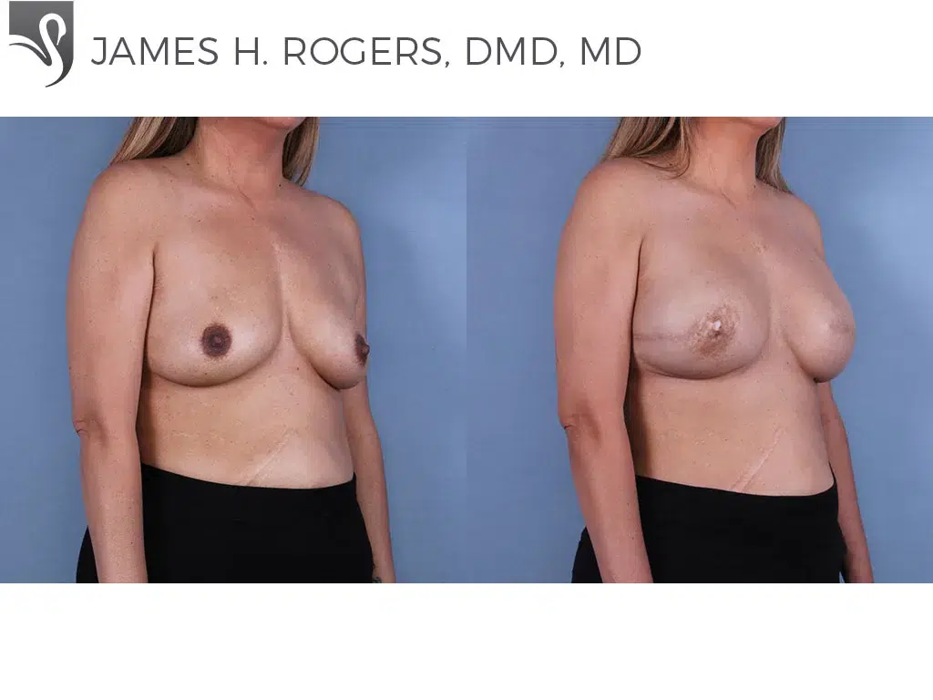 Before and After Image: Breast Reconstruction Case #66246 - right-front-oblique