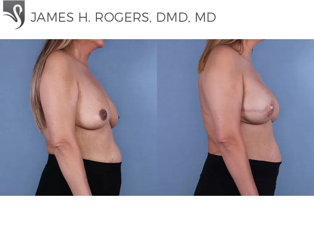 Before and After Image: Breast Reconstruction Case #66246 - right-side
