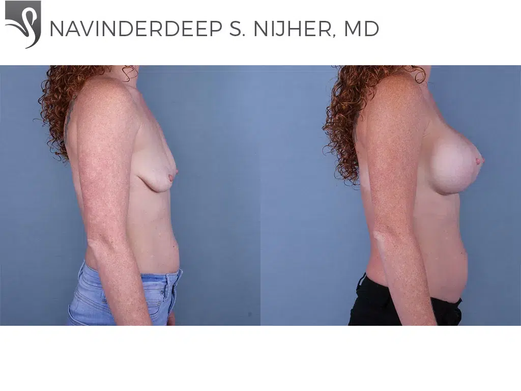 Before and After Image: Breast Lift (Mastopexy) Case #66402 - right-side