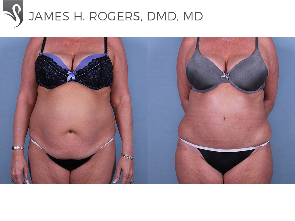 Before and After Image: Abdominoplasty (Tummy Tuck) Case #66405 - front