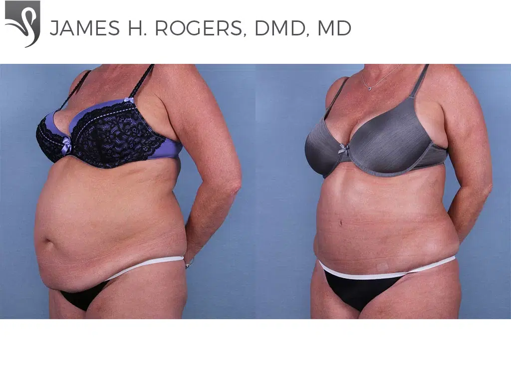 Before and After Image: Abdominoplasty (Tummy Tuck) Case #66405 - left-front-oblique