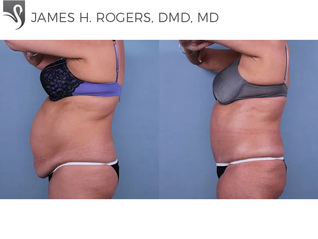 Before and After Image: Abdominoplasty (Tummy Tuck) Case #66405 - left-side