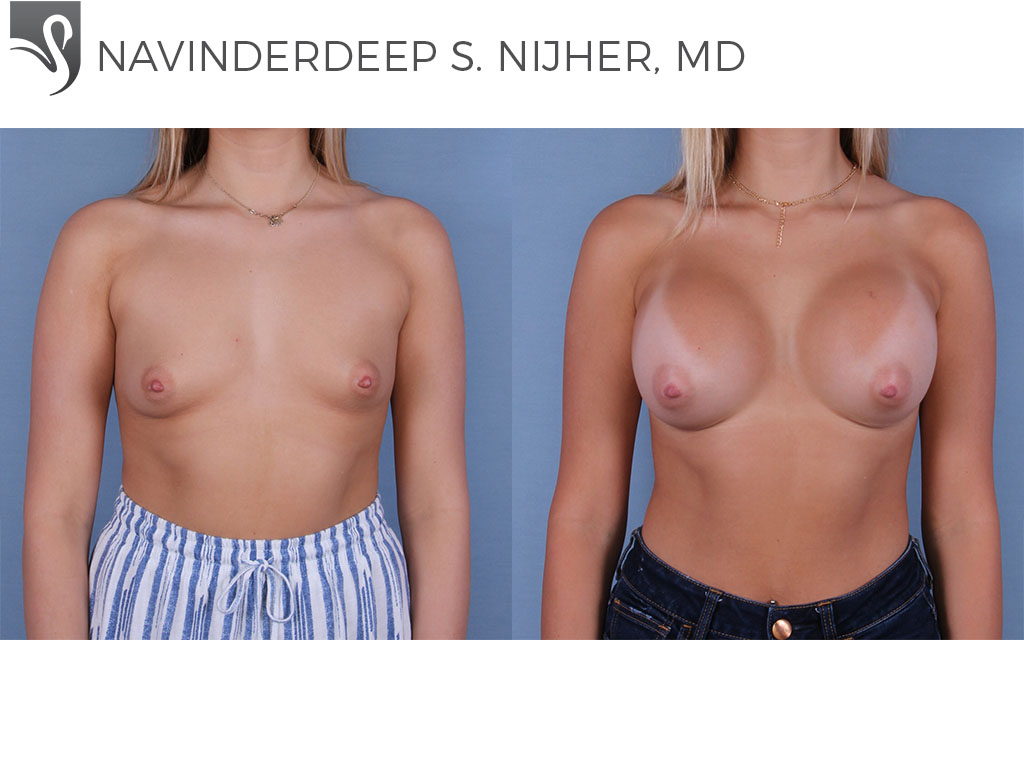 Before and After Image: Breast Augmentation Case #66512 - front