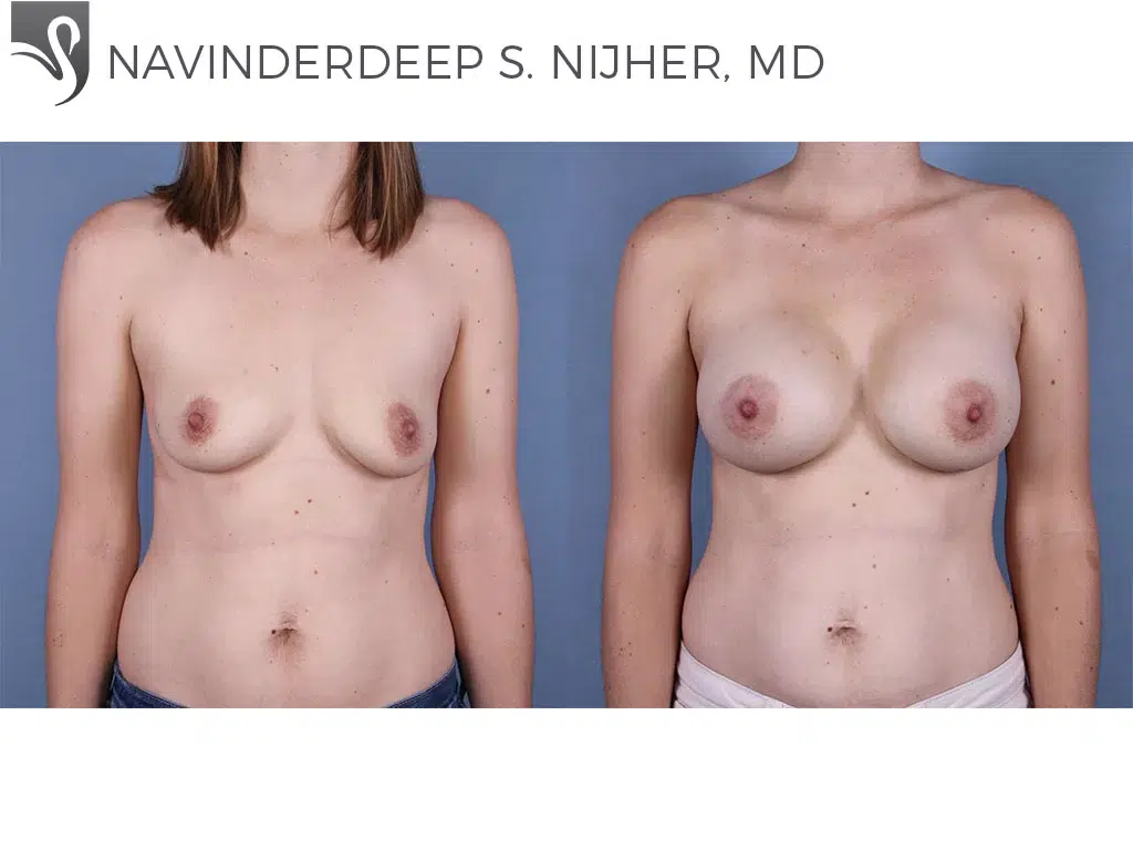 Before and After Image: Breast Augmentation Case #66642 - front