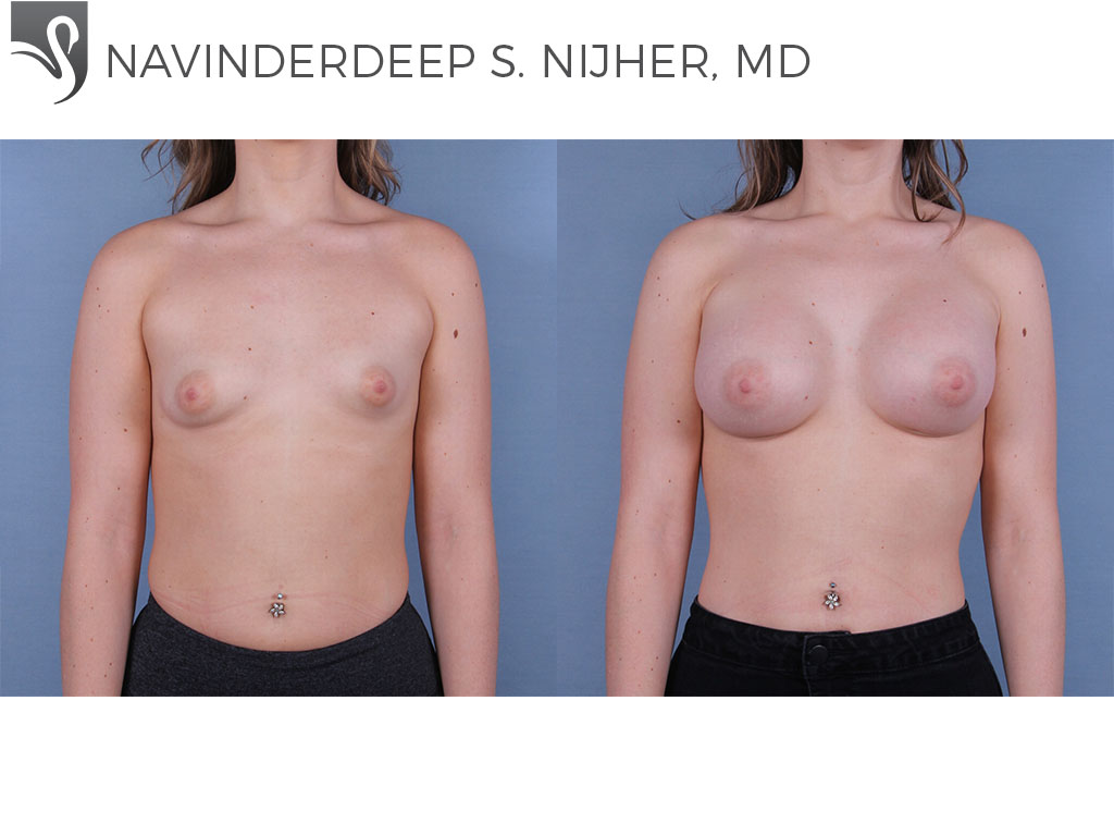 Before and After Image: Breast Augmentation Case #66763 - front