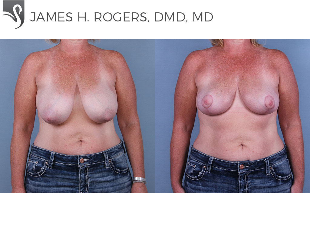 Before and After Image: Breast Lift (Mastopexy) Case #67101 - front
