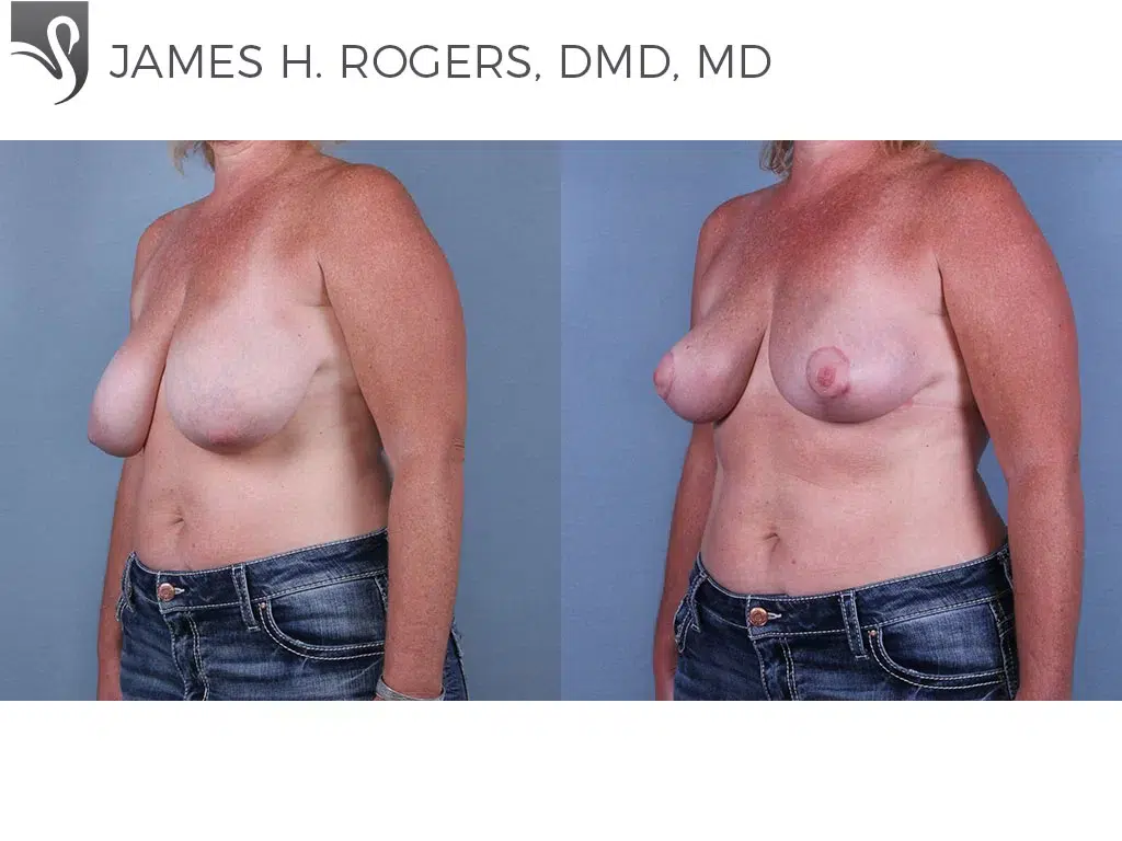 Before and After Image: Breast Lift (Mastopexy) Case #67101 - left-front-oblique