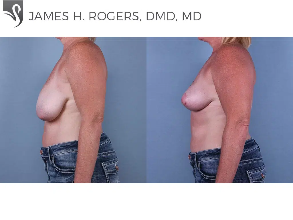 Before and After Image: Breast Lift (Mastopexy) Case #67101 - left-side
