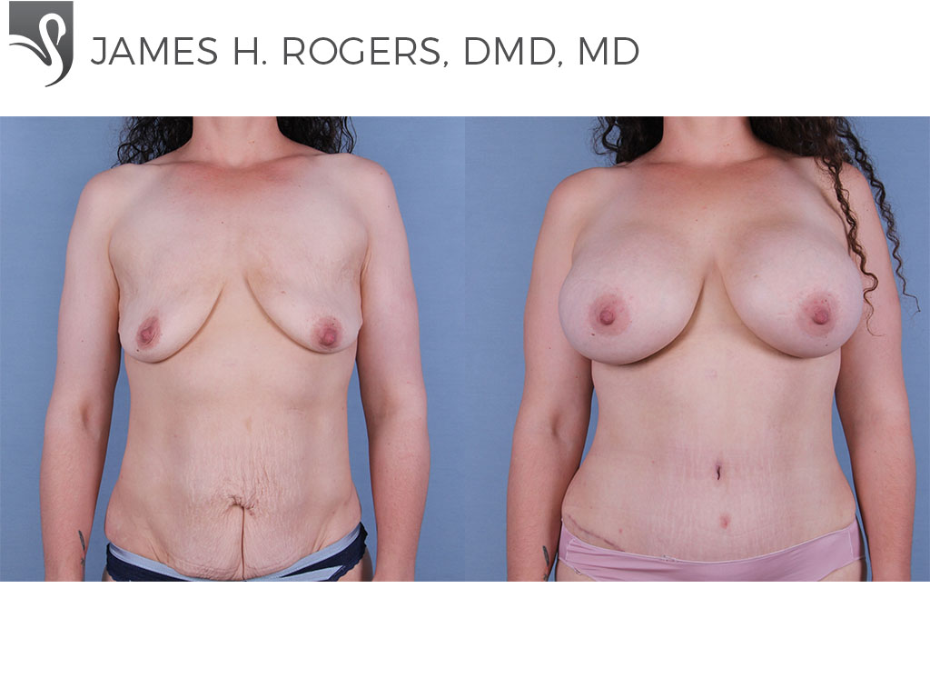 Before and After Image: Breast Augmentation Case #67179 - front
