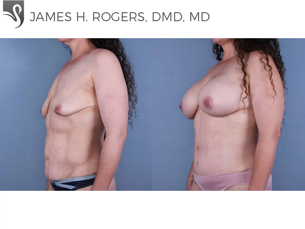 Before and After Image: Breast Augmentation Case #67179 - left-front-oblique