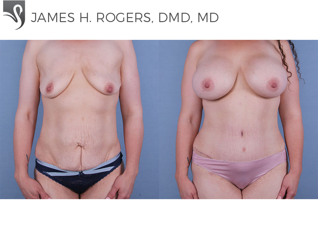 Before and After Image: Abdominoplasty (Tummy Tuck) Case #67179 - front