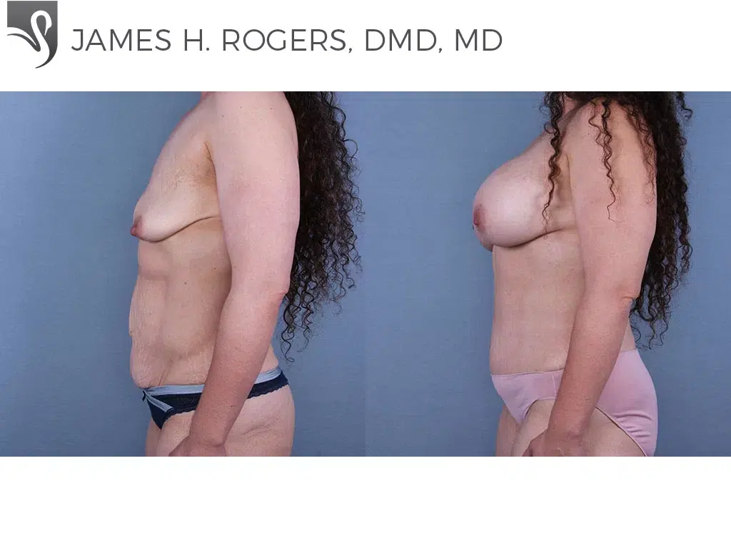 Before and After Image: Abdominoplasty (Tummy Tuck) Case #67179 - left-side