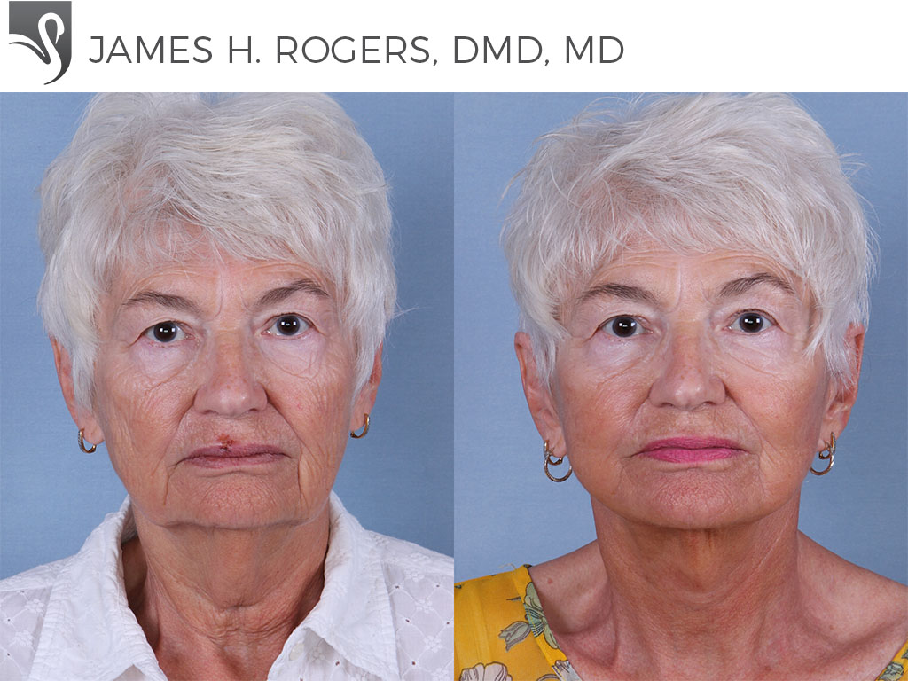 Before and After Image: Face Lift Case #67573 - front