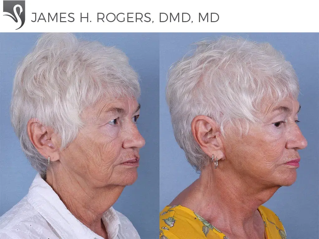 Before and After Image: Face Lift Case #67573 - right-front-oblique