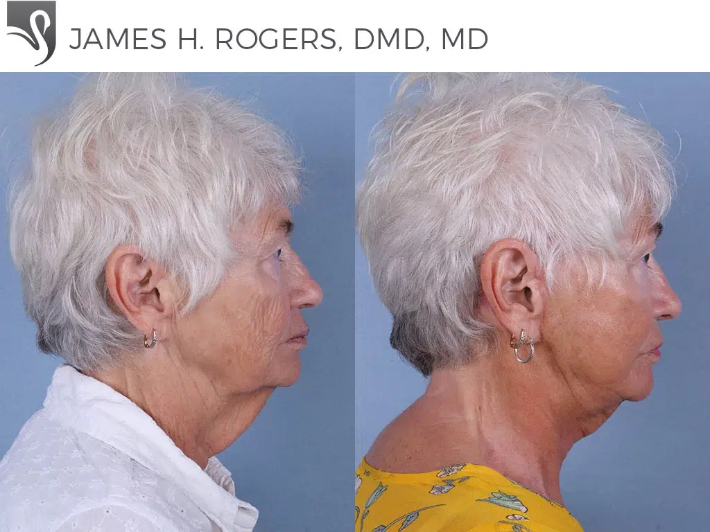 Before and After Image: Face Lift Case #67573 - right-side