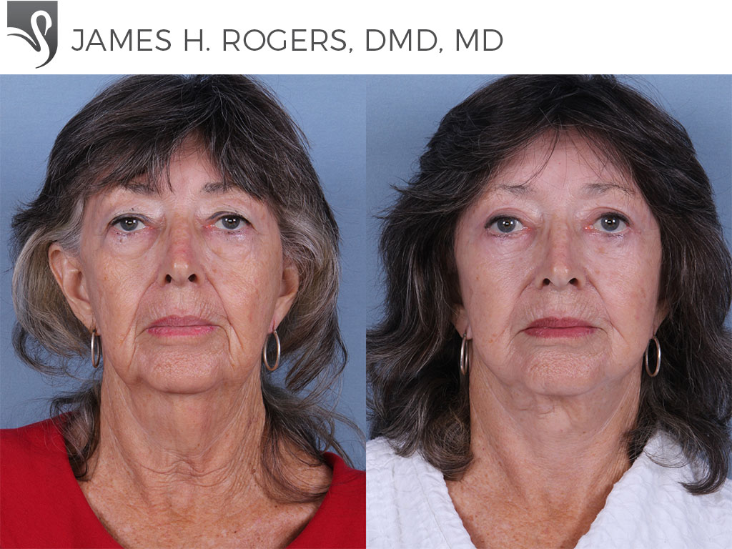 Before and After Image: Face Lift Case #67603 - front