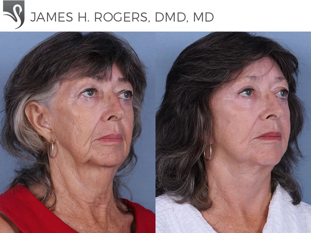 Before and After Image: Face Lift Case #67603 - right-front-oblique