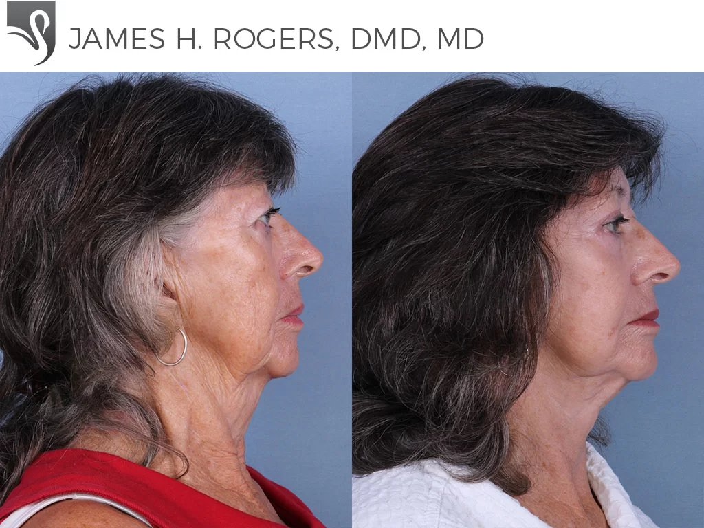 Before and After Image: Face Lift Case #67603 - right-side
