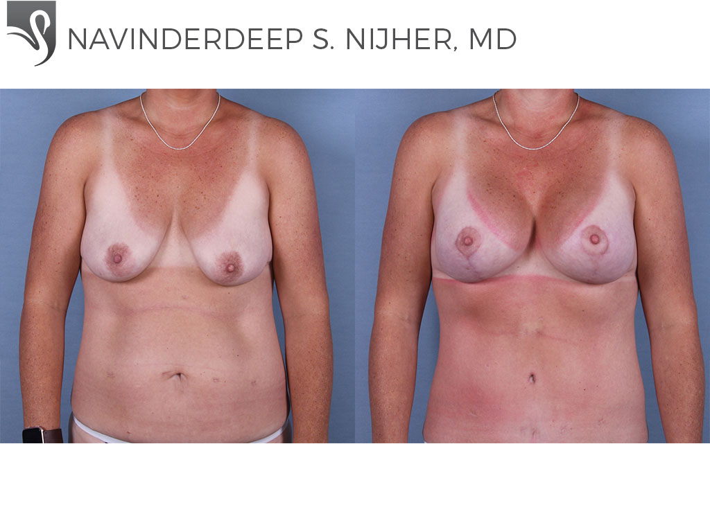 Before and After Image: Breast Lift (Mastopexy) Case #67646 - front