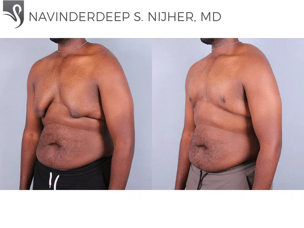 Before and After Image: Male Breast Reduction Case #67837 - left-front-oblique