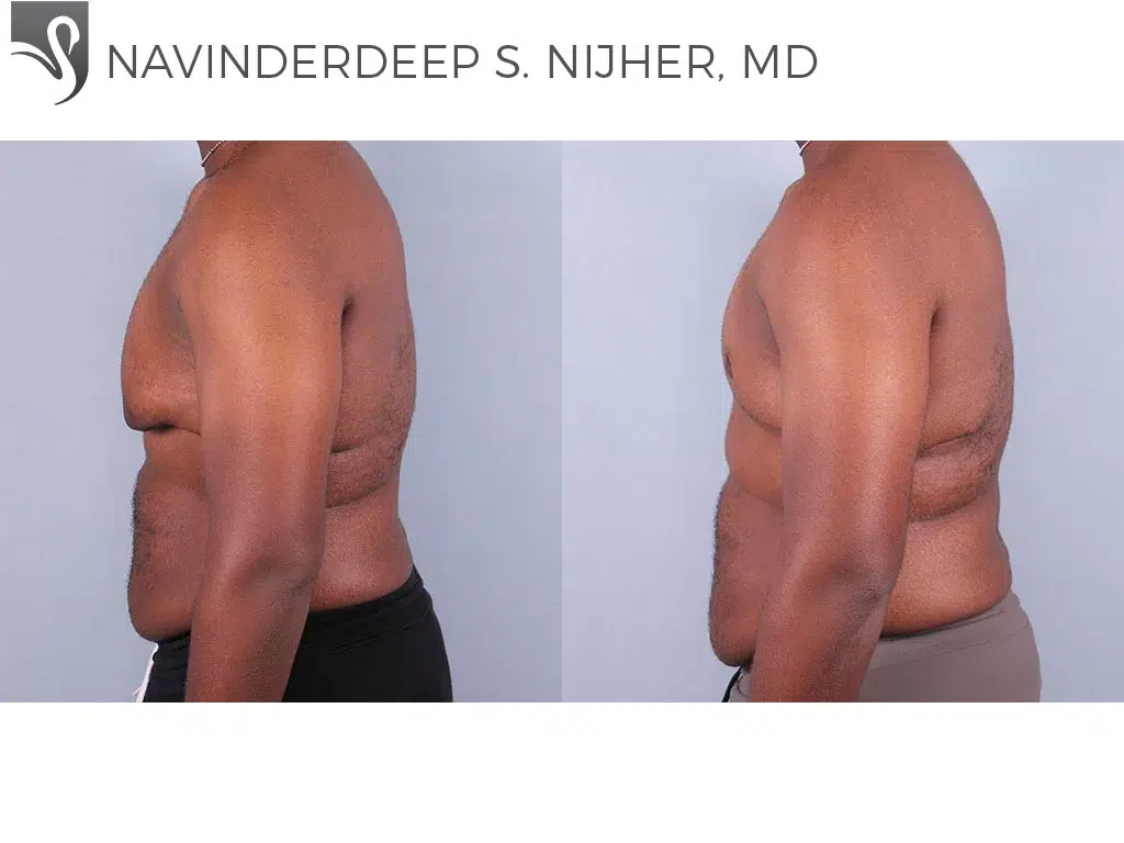 Before and After Image: Male Breast Reduction Case #67837 - left-side