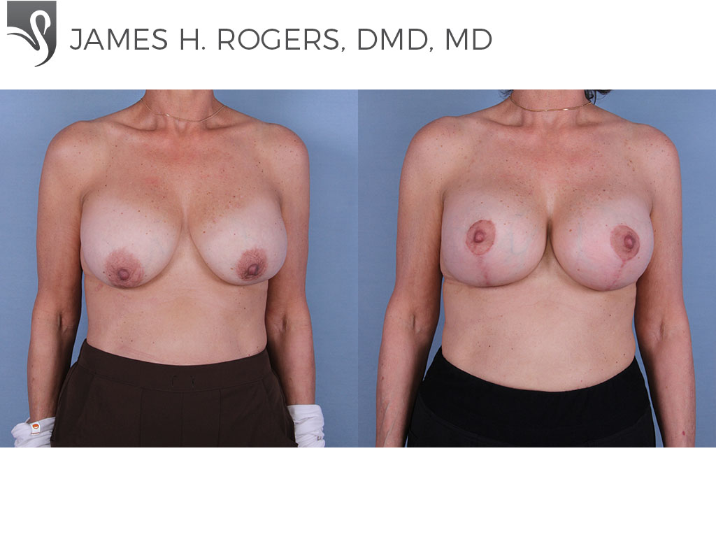 Before and After Image: Breast Revisions Case #67883 - front