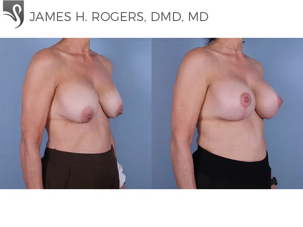 Before and After Image: Breast Revisions Case #67883 - right-front-oblique