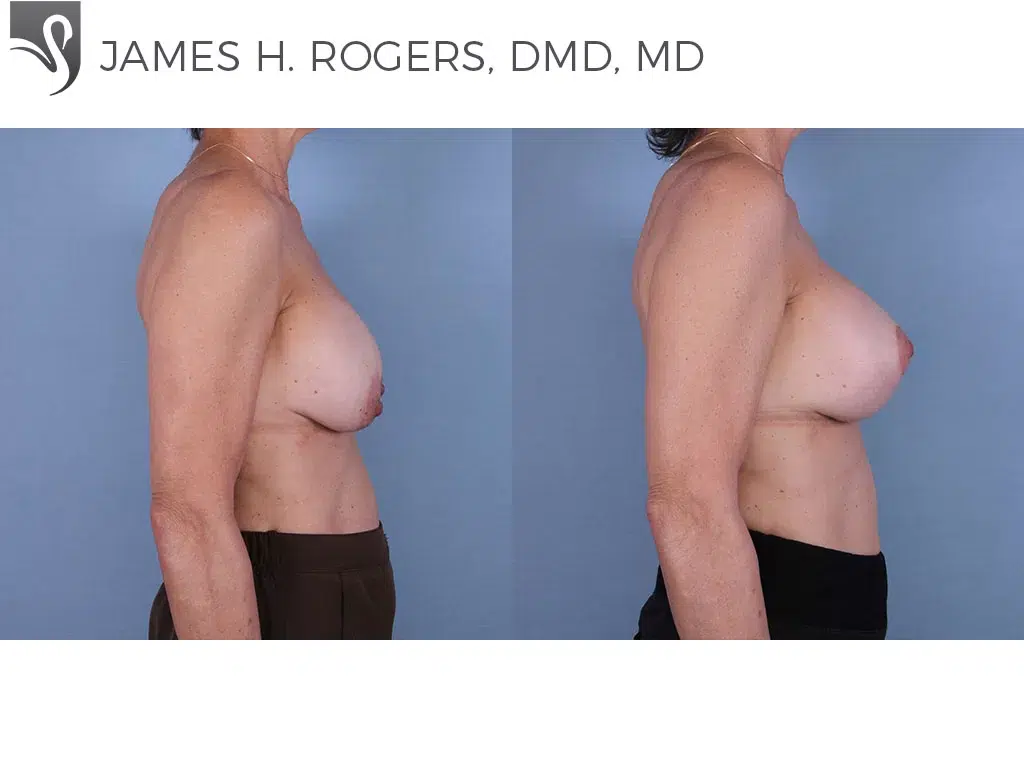 Before and After Image: Breast Revisions Case #67883 - right-side