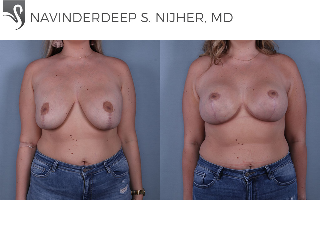 Before and After Image: Breast Lift (Mastopexy) Case #67931 - front