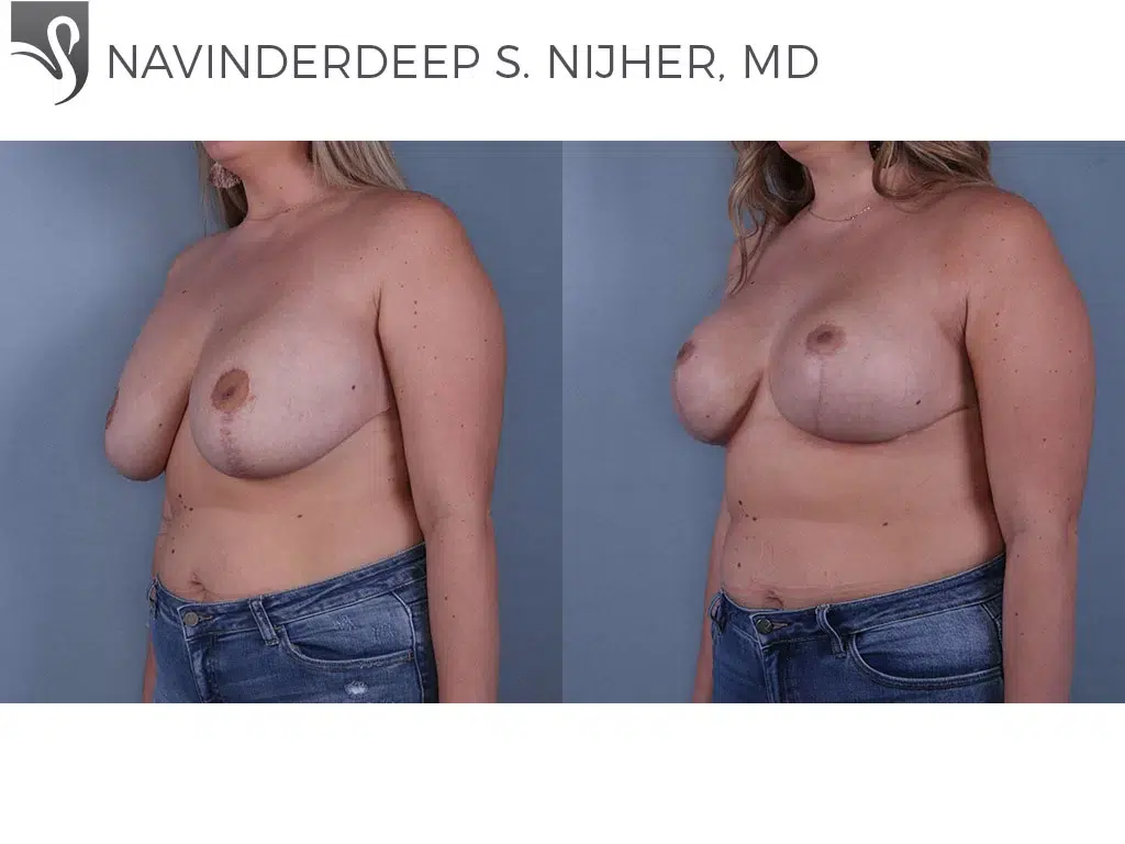 Before and After Image: Breast Lift (Mastopexy) Case #67931 - left-front-oblique