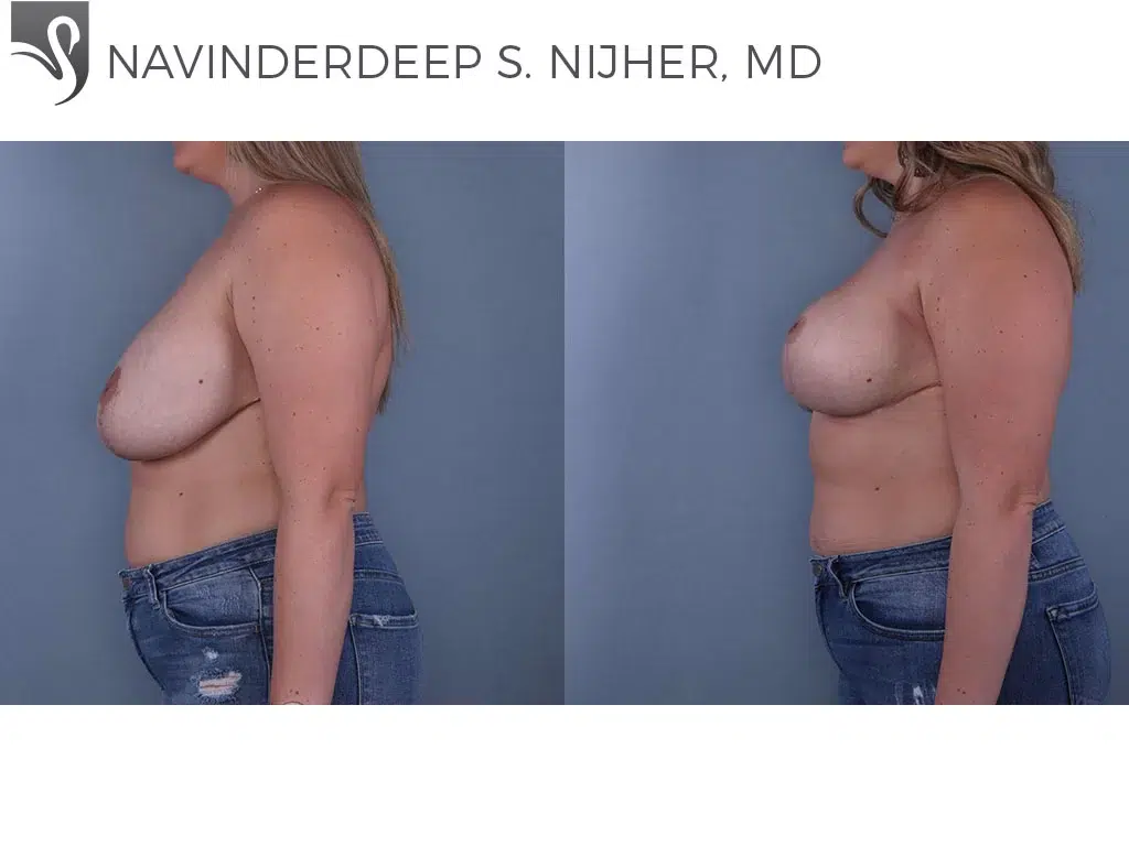 Before and After Image: Breast Lift (Mastopexy) Case #67931 - left-side