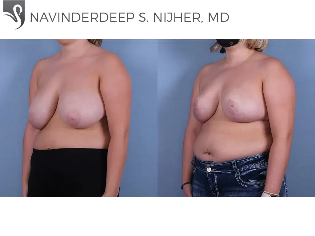 Before and After Image: Female Breast Reduction Case #68049 - left-front-oblique