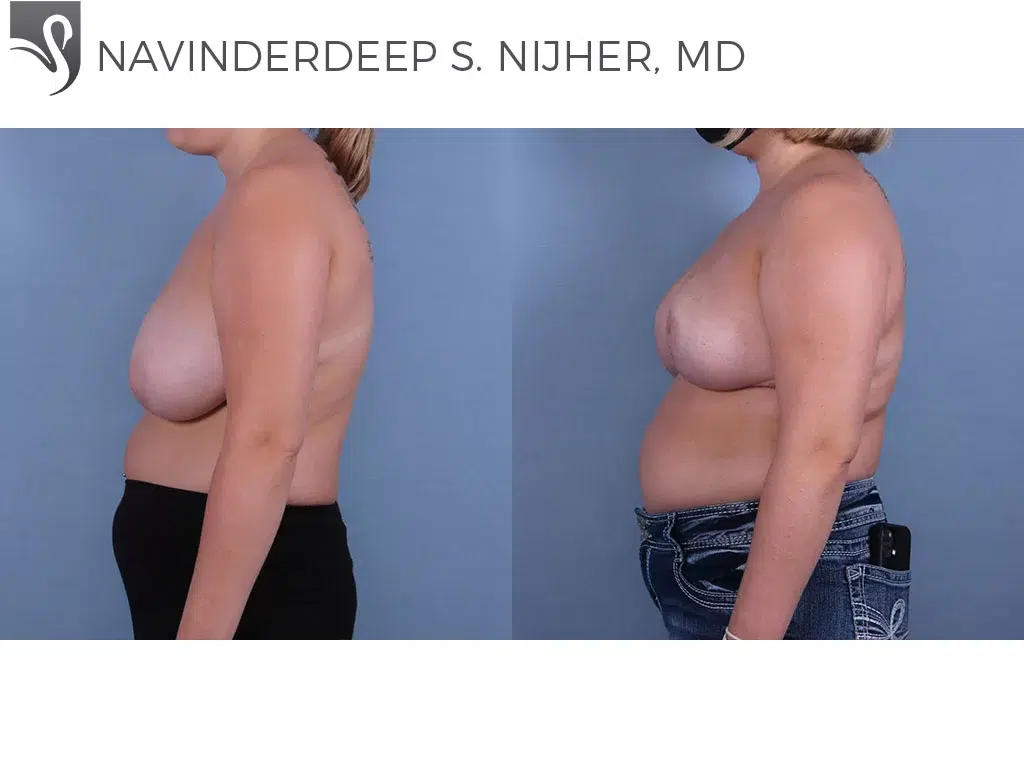 Before and After Image: Female Breast Reduction Case #68049 - left-side